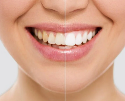 Sonrisa Radiante: Descubre el Blanqueador Dental que Transformará tu Sonrisa