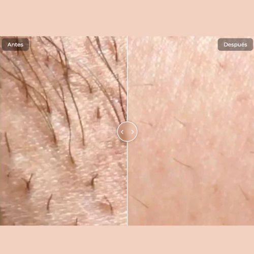 Depilación Permanente en Casa con Tecnología IPL PRO