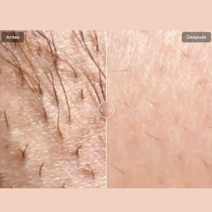 Depilación Permanente en Casa con Tecnología IPL PRO