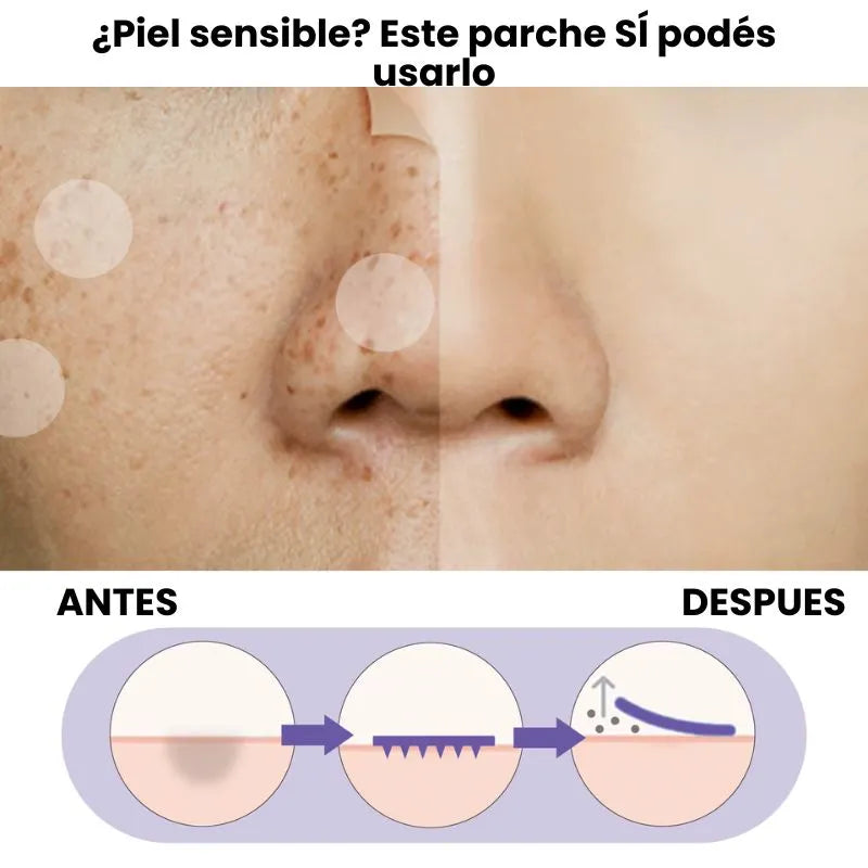 Parche Suave que Elimina Manchas — Ideal para Piel Sensible