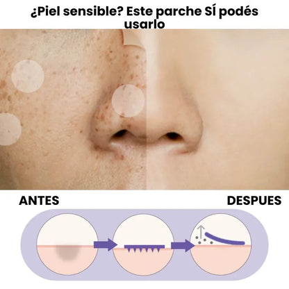 Parche Suave que Elimina Manchas — Ideal para Piel Sensible
