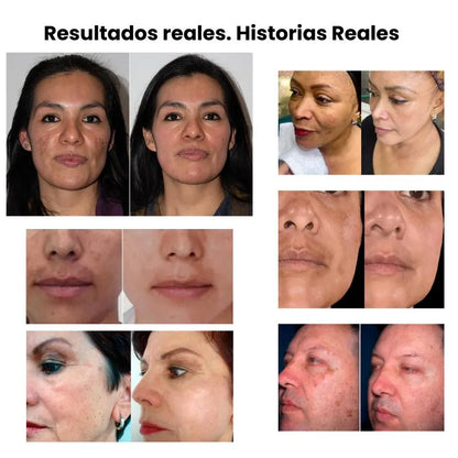 Parche Suave que Elimina Manchas — Ideal para Piel Sensible