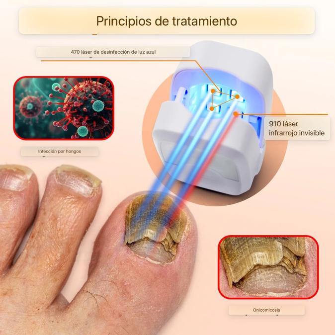 ¡Recupera la Confianza en tus Pies con Nuestro Tratamiento Láser Anti-Hongos En Semanas!