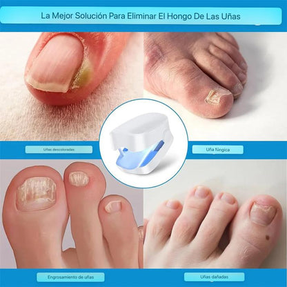 ¡Recupera la Confianza en tus Pies con Nuestro Tratamiento Láser Anti-Hongos En Semanas!