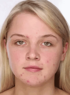 Di Adiós al Acné y las Manchas con Este Serum Milagroso