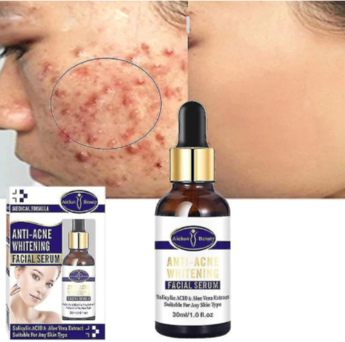 Di Adiós al Acné y las Manchas con Este Serum Milagroso