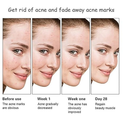 Di Adiós al Acné y las Manchas con Este Serum Milagroso